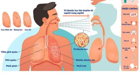 Bệnh lao phổi: Triệu chứng và cách phòng ngừa