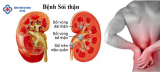 Bài tập tốt cho người sỏi thận
