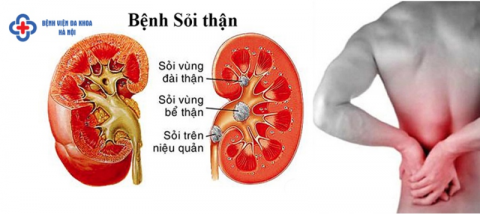 Bài tập tốt cho người sỏi thận
